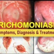 Trichomoniasis (Trich): Causes, Symptoms, Diagnosis & Treatment Trichomoniasis Trich Symptoms men women, Causes trichomoniasis Treatment, Medication, trichomoniasis discharge, cervix pictures