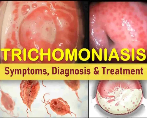Trichomoniasis Trich Symptoms men women, Causes trichomoniasis Treatment, Medication, trichomoniasis discharge, cervix pictures