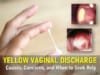 yellow vaginal discharge, causes of yellow vaginal discharge without odor, yellow discharge before or after period, light thick yellow yellow-green discharge, normal vs. abnormal yellow discharge