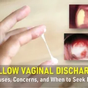 yellow vaginal discharge, causes of yellow vaginal discharge without odor, yellow discharge before or after period, light thick yellow yellow-green discharge, normal vs. abnormal yellow discharge
