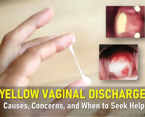 yellow vaginal discharge, causes of yellow vaginal discharge without odor, yellow discharge before or after period, light thick yellow yellow-green discharge, normal vs. abnormal yellow discharge
