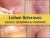 lichen sclerosus pictures, vulva, self care, home remedies, smell, diet, Itchy, painful patches of thin, white, wrinkled skin, white spots on vagina