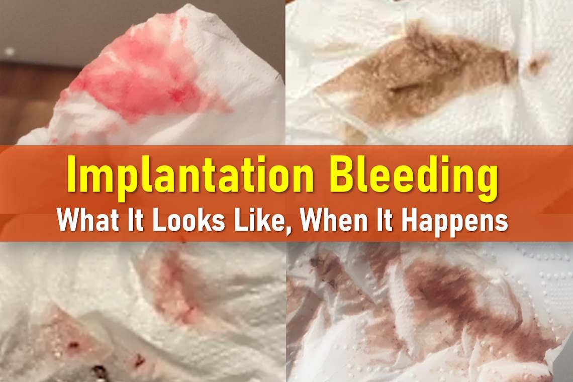 implantation bleeding pictures, when it happens, what it looks like