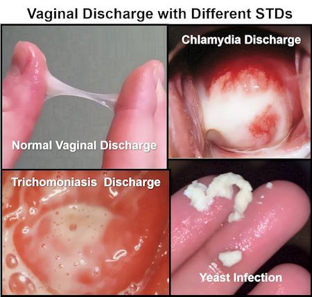 Vaginal Discharge and STDs, STI Discharge Color, STD Discharge real pictures