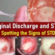 Vaginal Discharge and STDs, STI Discharge Color, what STD Discharge Look Like