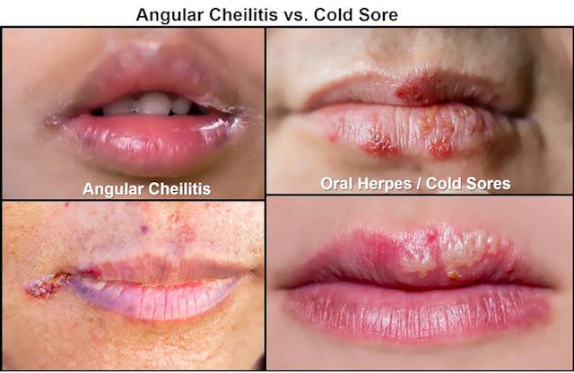 angular cheilitis vs cold sore pictures, sores corner of mouth, cracked mouth corners