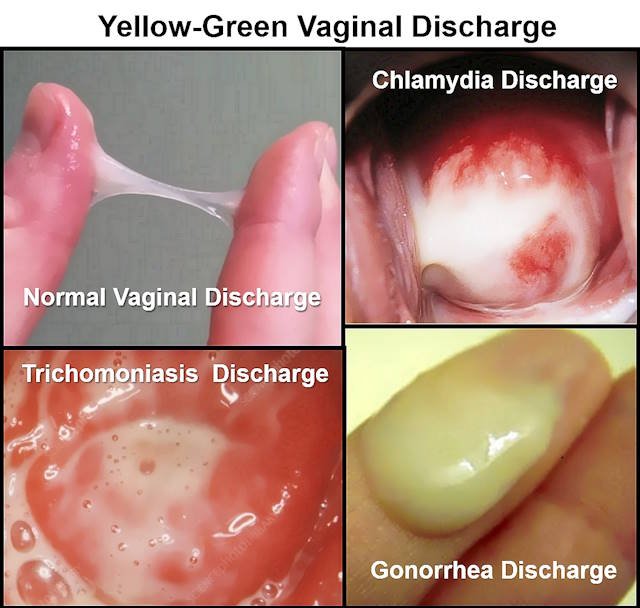 Green Discharge, Light Green, Yellow Green Discharge without odor, Green Discharge During Pregnancy