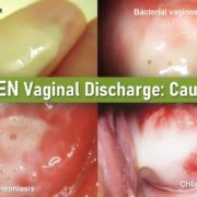 Green Discharge, Light Green, Yellow Green Discharge without odor, Green Discharge During Pregnancy