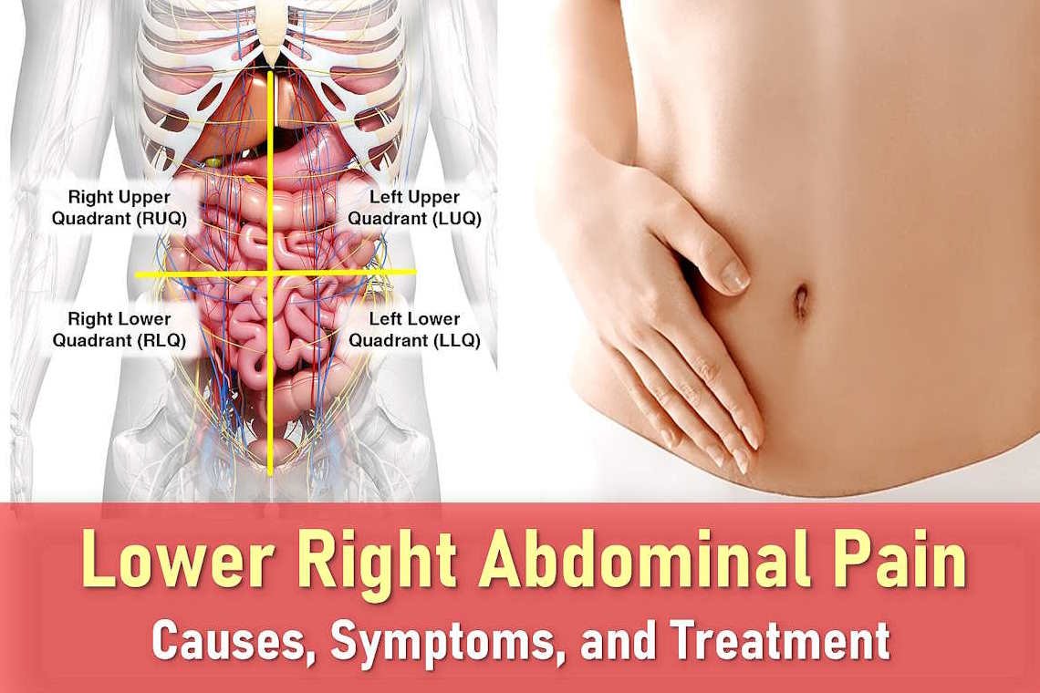 Pain in lower right abdomen female, near hip bone, dull, sharp pain Right lower quadrant (RLQ) pain