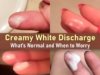 white discharge, white creamy discharge, creamy discharge, creamy white discharge, thick white
