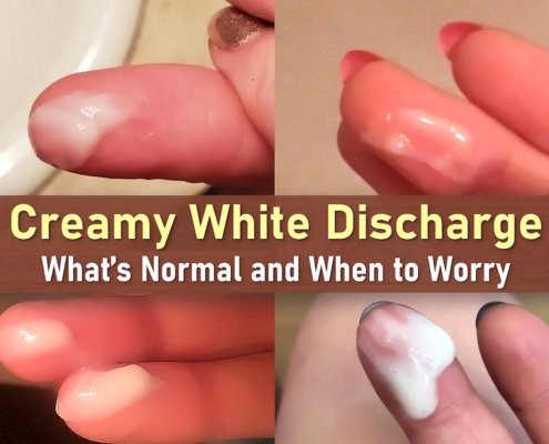 white discharge, white creamy discharge, creamy discharge, creamy white discharge, thick white