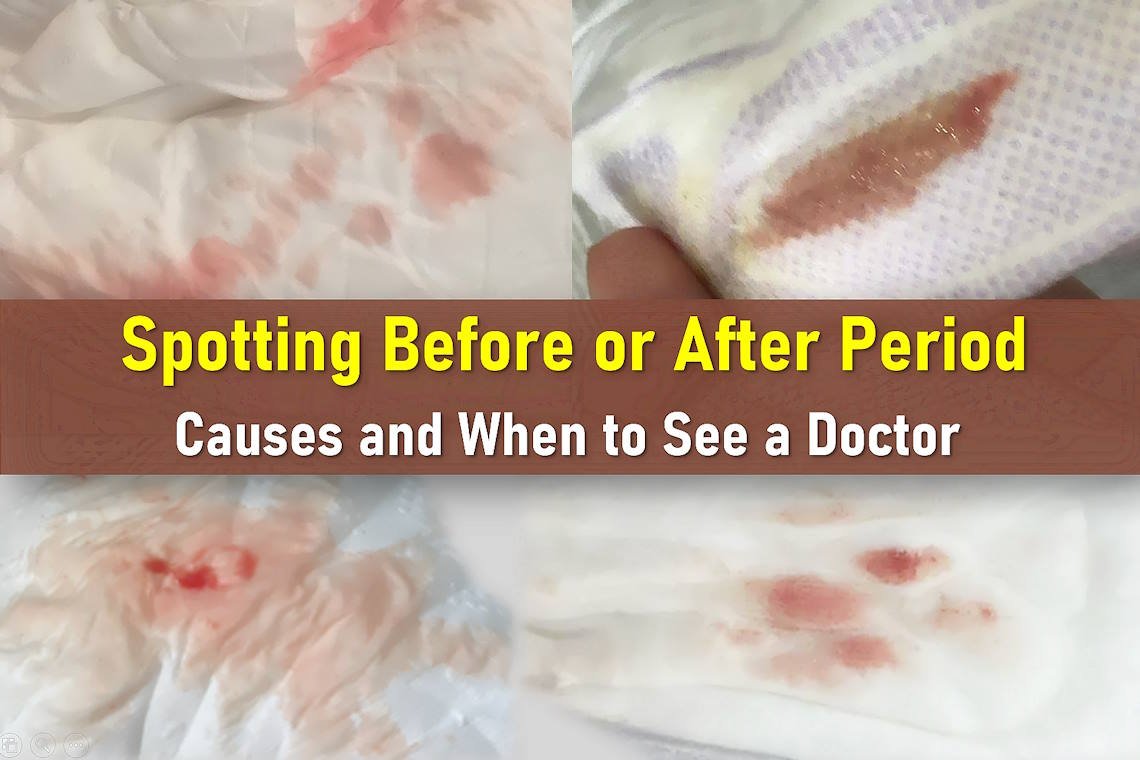 spotting before period, spotting after period, what does spotting look like, spotting vs period