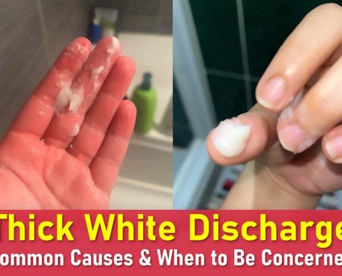 thick white discharge, thick white discharge no smell, thick white discharge before period, clumpy white discharge