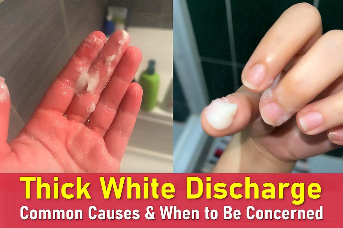 thick white discharge, thick white discharge no smell, thick white discharge before period, clumpy white discharge