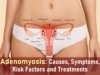adenomyosis symptoms, what is adenomyosis, uterine adenomyosis, adenomyosis treatment, adenomyosis medication