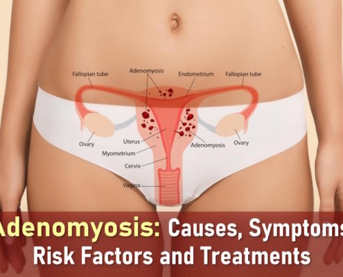 adenomyosis symptoms, what is adenomyosis, uterine adenomyosis, adenomyosis treatment, adenomyosis medication