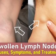 swollen lymph nodes, swollen lymph nodes in neck, swollen lymph nodes armpit, swollen lymph node behind ear