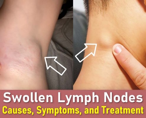 swollen lymph nodes, swollen lymph nodes in neck, swollen lymph nodes armpit, swollen lymph node behind ear