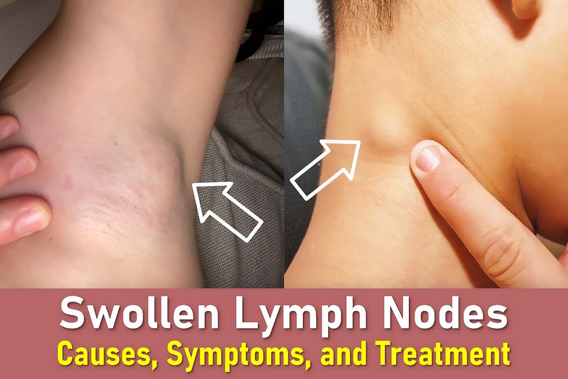 swollen lymph nodes, swollen lymph nodes in neck, swollen lymph nodes armpit, swollen lymph node behind ear